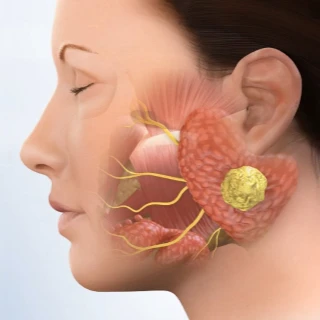 Salivary Gland Surgery