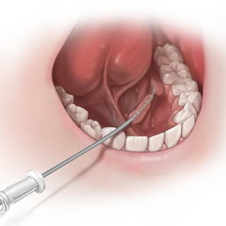 Sialendoscopy